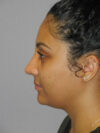 Rhinoplasty case #3519