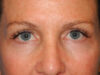 Blepharoplasty case #4960