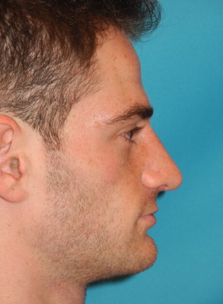 Rhinoplasty case #3520