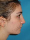 Rhinoplasty case #3521