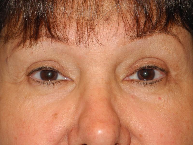 Blepharoplasty case #5141