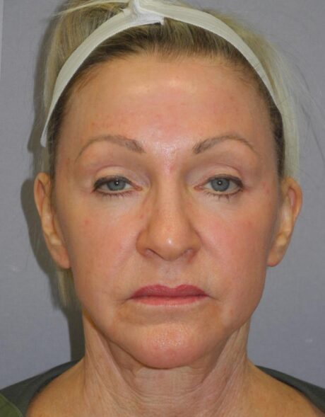 Blepharoplasty case #5153