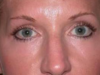 Blepharoplasty case #3924