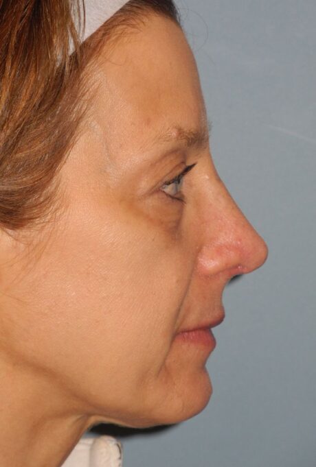 Rhinoplasty case #3522