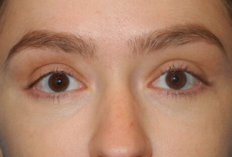 Blepharoplasty case #5197