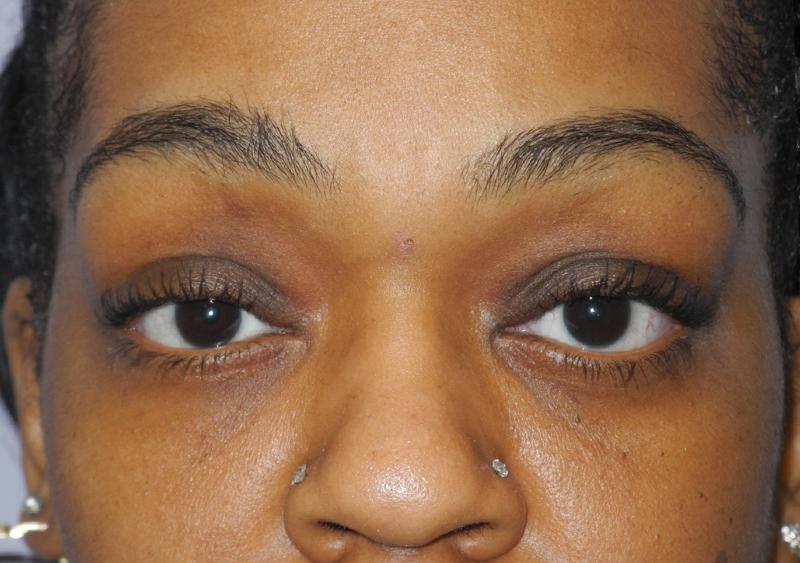 Blepharoplasty case #5204