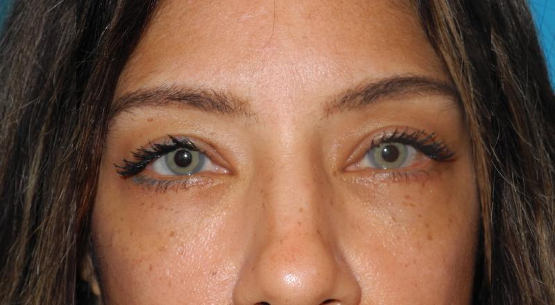 Blepharoplasty case #5246