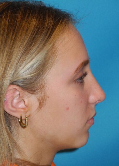 Rhinoplasty case #3523