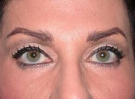 Blepharoplasty case #4043