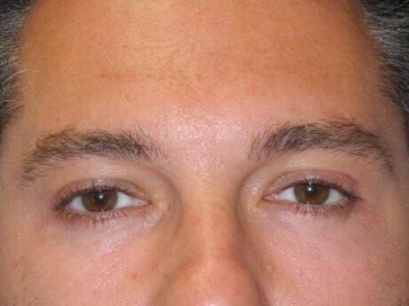 Blepharoplasty case #5270