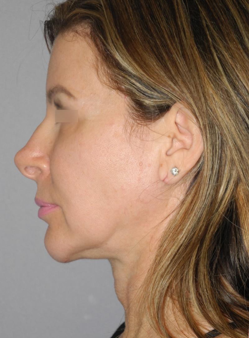 Chin Implant case #5301