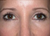 Blepharoplasty case #4062