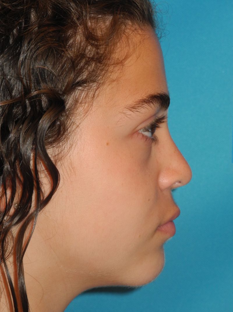 Rhinoplasty case #3525