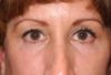 Blepharoplasty case #4065