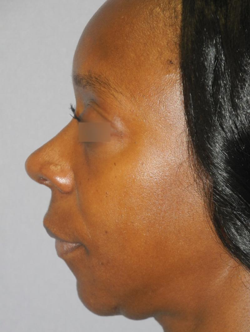 Rhinoplasty case #3527