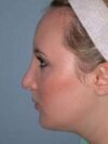 Chin Implant case #3529