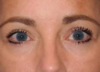 Blepharoplasty case #4075