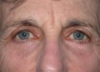 Blepharoplasty case #4080