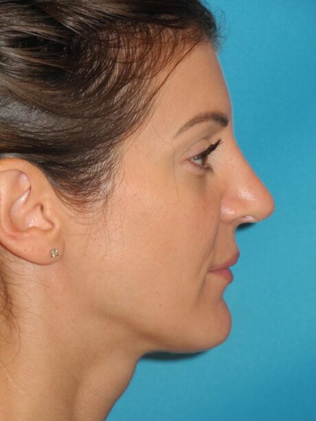 Rhinoplasty case #3680