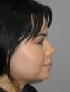 Rhinoplasty case #3681