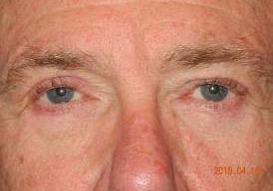 Blepharoplasty case #4117