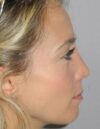 Rhinoplasty case #3682