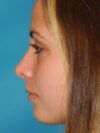 Rhinoplasty case #3683