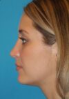 Rhinoplasty case #3685