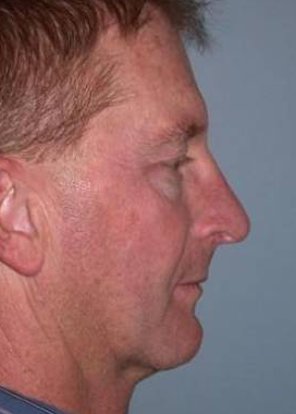 Chin Implant case #4335