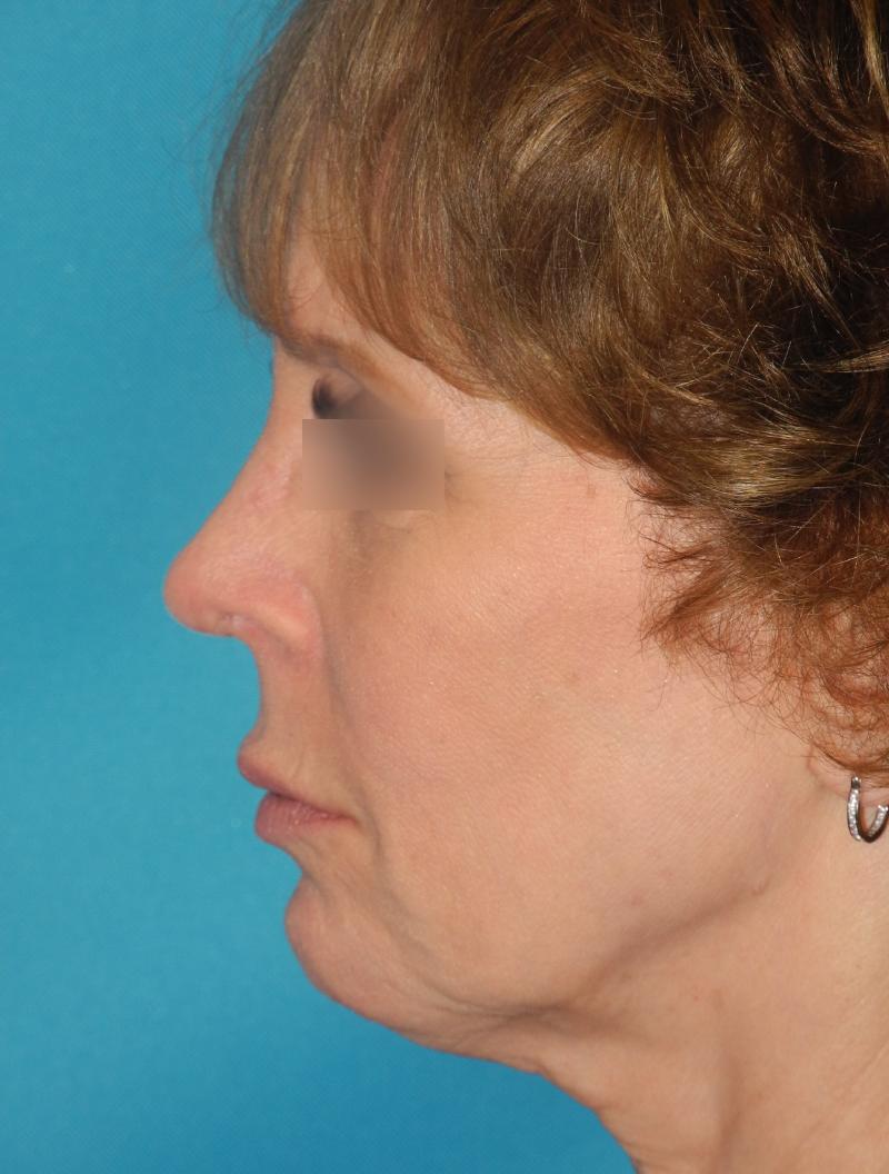 Revision Rhinoplasty case #3464