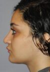 Rhinoplasty case #3687