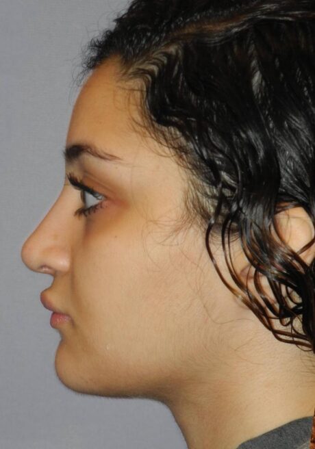 Rhinoplasty case #3687