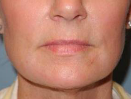 CO2 Laser Resurfacing case #4587