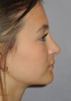 Rhinoplasty case #3688