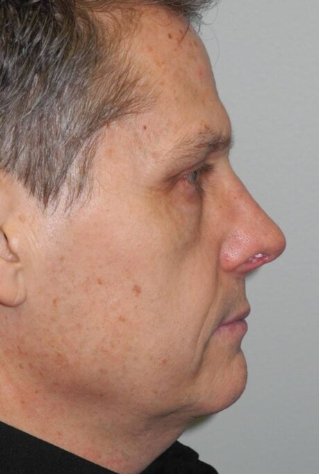 Rhinoplasty case #3689