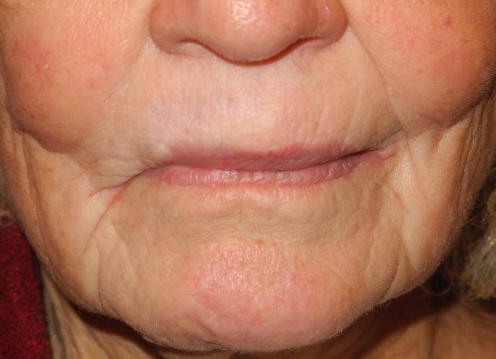 CO2 Laser Resurfacing case #4678