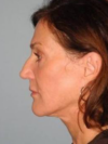 CO2 Laser Resurfacing case #4680