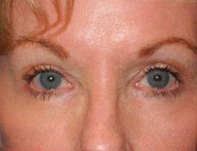 Blepharoplasty case #4729