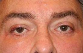 Blepharoplasty case #4746