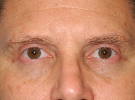 Blepharoplasty case #3977