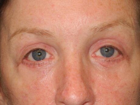 Blepharoplasty case #4024