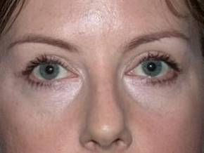 Blepharoplasty case #4050