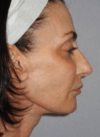 Neck Lift case #5281