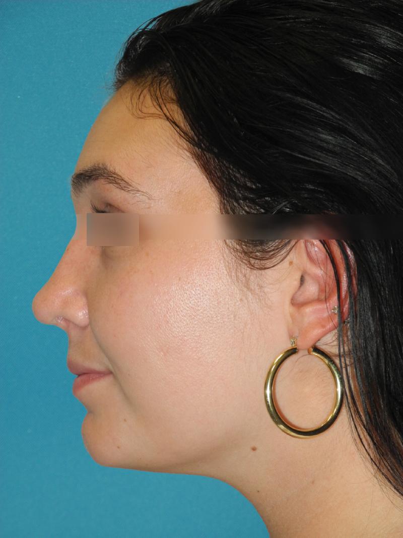 Revision Rhinoplasty case #3466