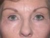 Blepharoplasty case #4058