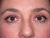 Blepharoplasty case #4083