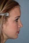 Rhinoplasty case #5414