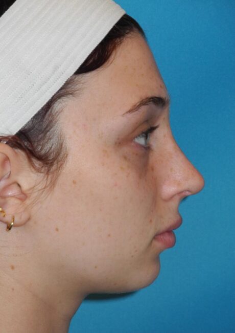 Rhinoplasty case #4122