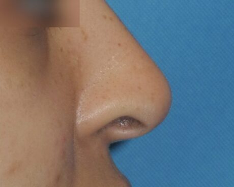 Liquid Rhinoplasty case #4124