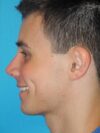 Rhinoplasty case #4125